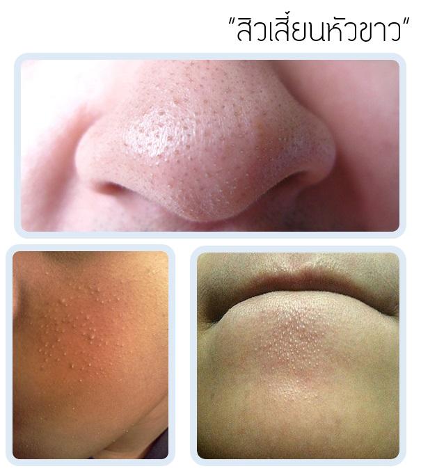 สิวเสี้ยนหัวขาว สิวเสี้ยนหัวขาว
