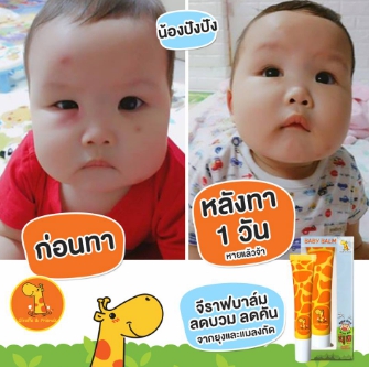 ยุงกัดลูกทายาอะไรดี ที่หายเร็ว ไม่บวม ไม่คัน ไม่ทิ้งรอยดำ? ยุงกัดลูกทายาอะไรดี ที่หายเร็ว ไม่บวม ไม่คัน ไม่ทิ้งรอยดำ?
